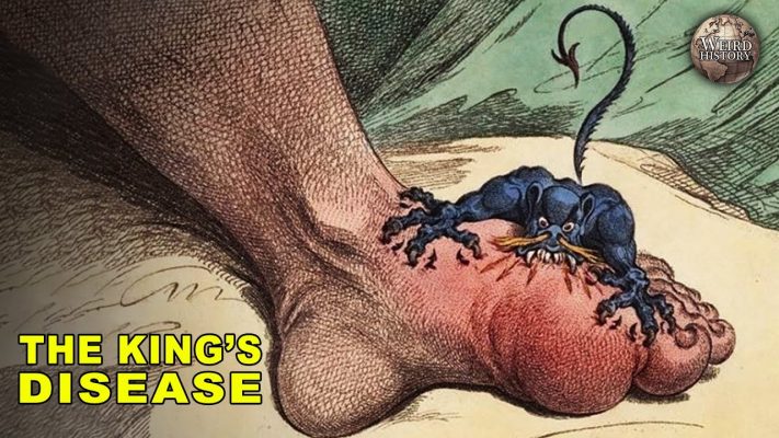 The History of Gout | The Disease of Kings