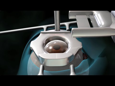 Laser Eye Surgery (LASIK)